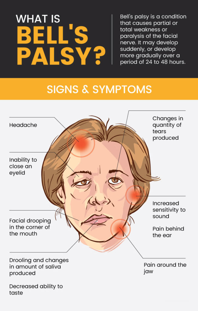 Bell’s Palsy (+ 13 Natural Treatments for Bell’s Palsy Symptoms ...