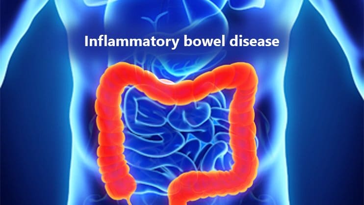 inflammatory-bowel-disease-or-irritable-bowel-syndrome-department-of