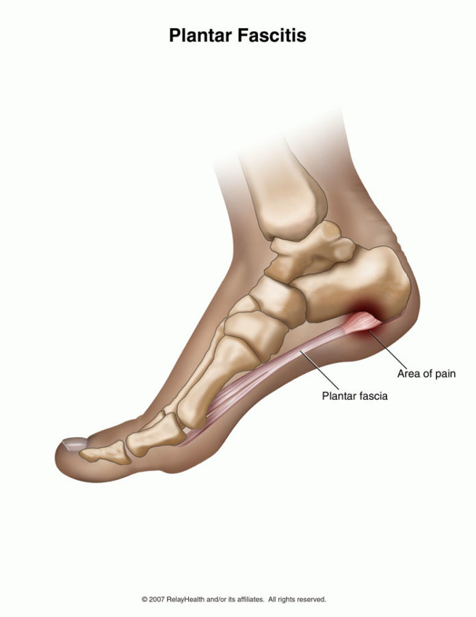 Plantar Fasciitis Condition And How To Treat It - MKExpress.net